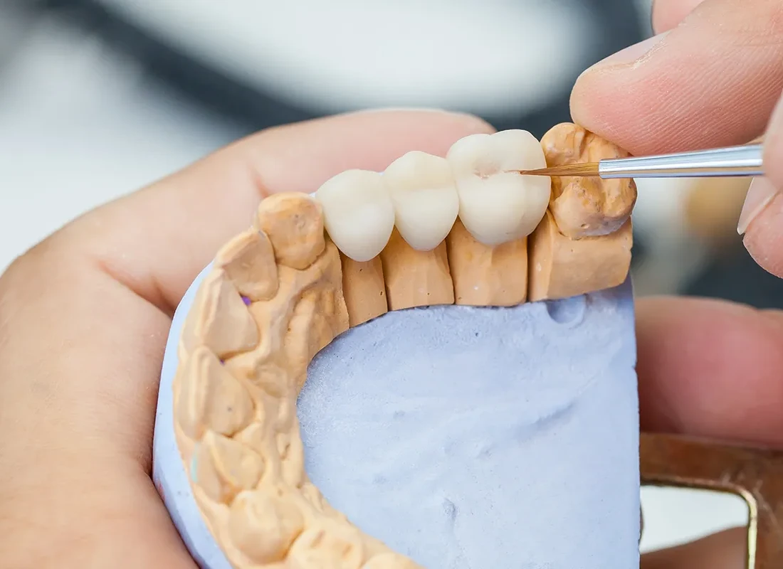 Dental-Bridge.webp