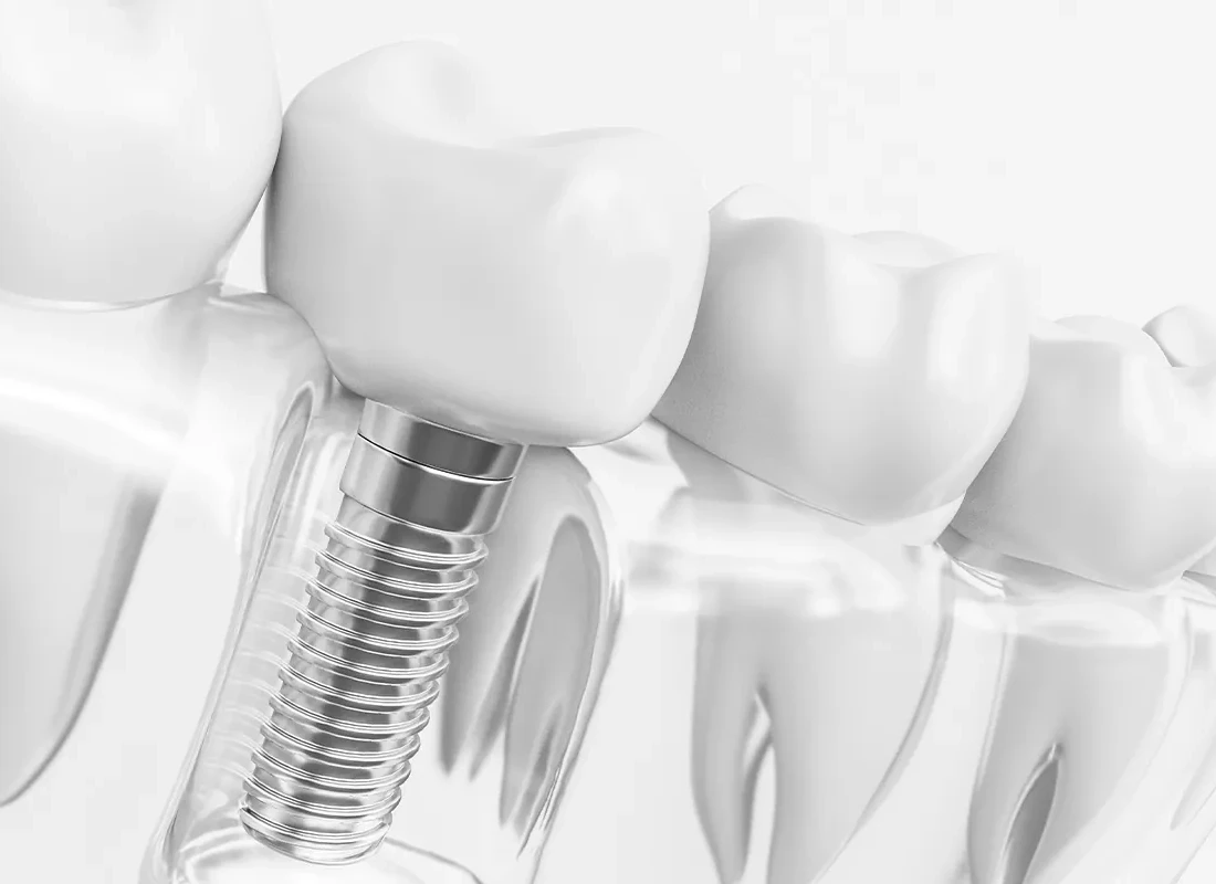 Dental-implant.webp