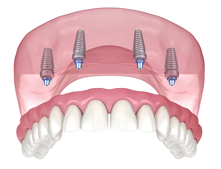 Full-Arch-All-on-4-Implants.webp