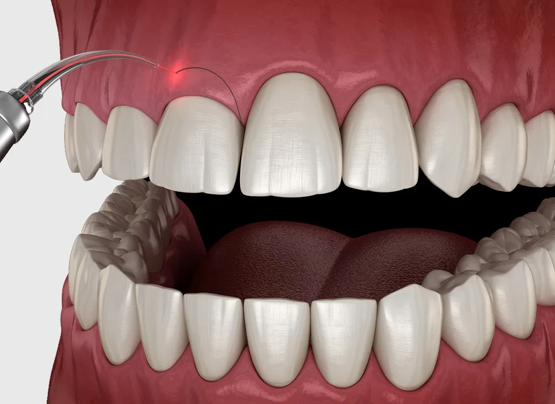 Gum-Contouring.webp