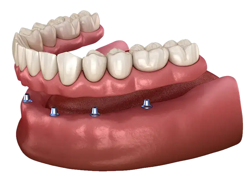 Implant-Supported-Dentures.webp