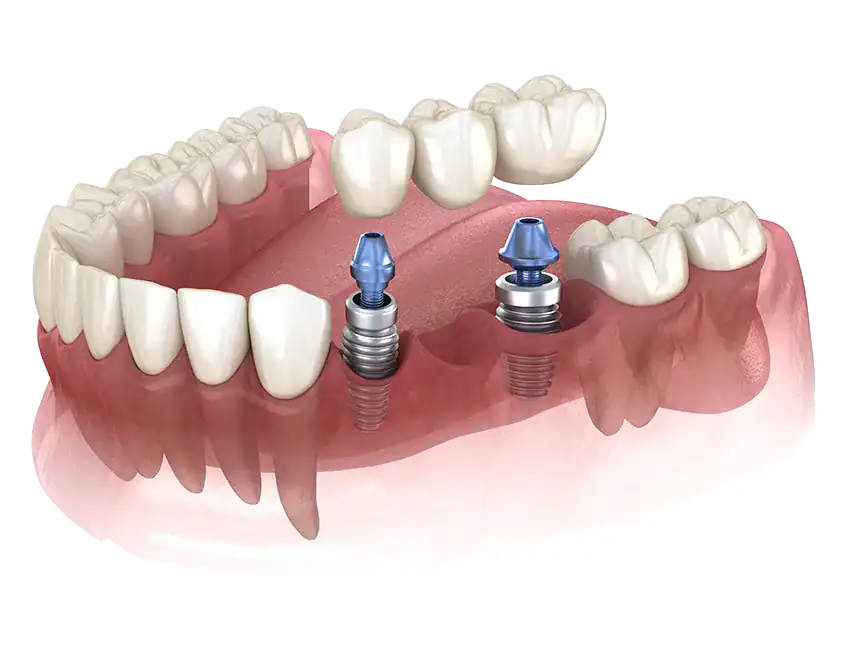 Multi-Tooth-Implant-Bridges.webp