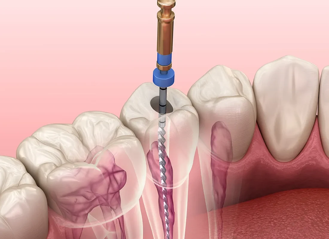Root-Canal.webp