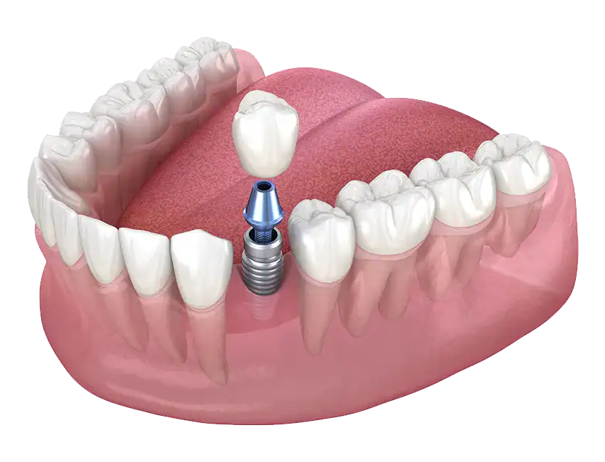 Single-Tooth-Implants.webp