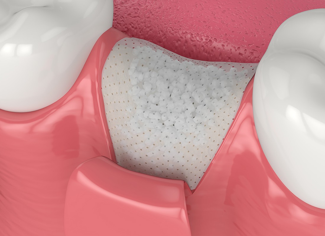 bone-grafting.jpg