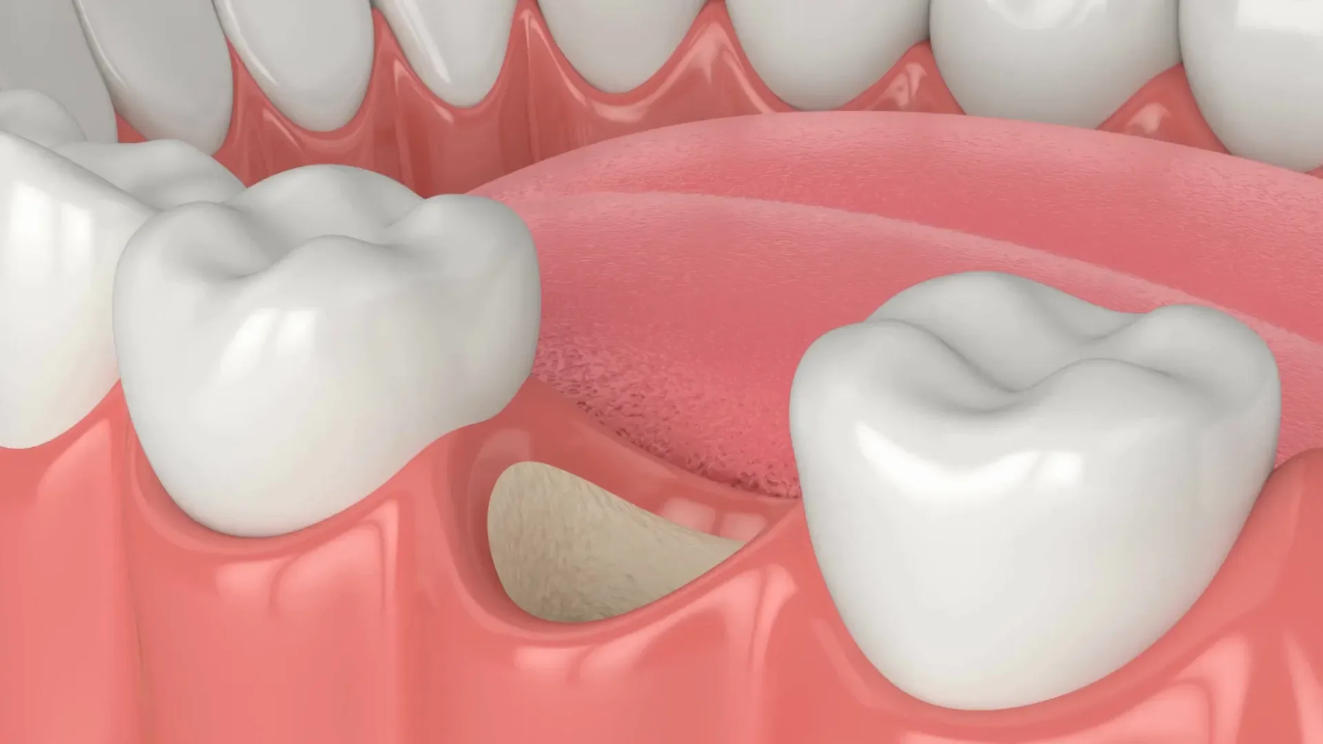 bone-grafting.webp