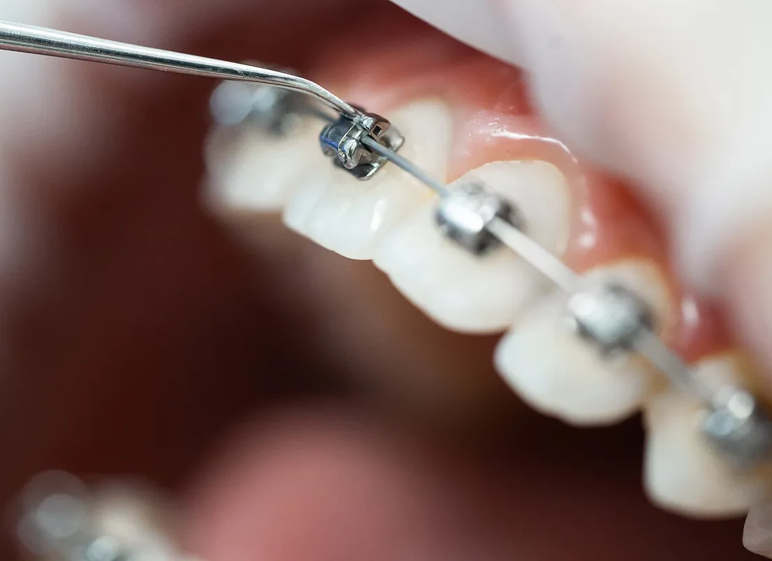 braces-3.webp