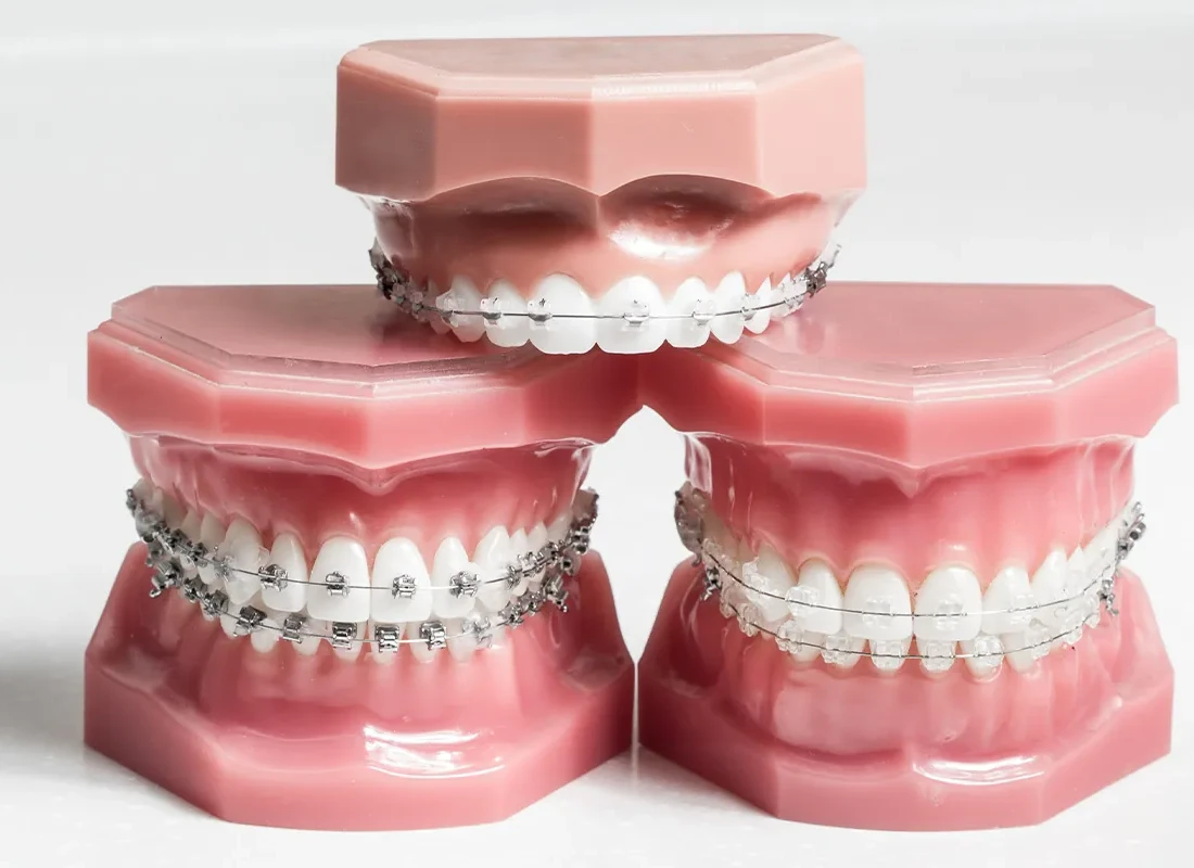 braces-type.webp