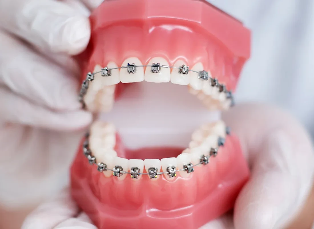 braces.webp