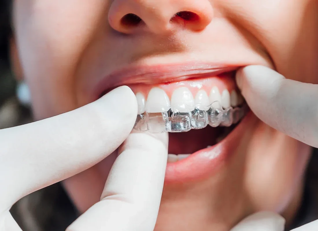 clear-aligners-dental.webp