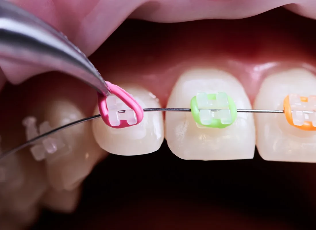color-braces.webp