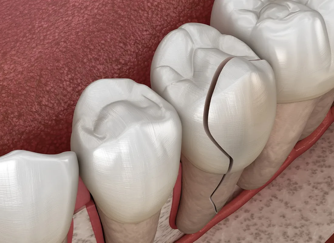 crack-tooth.webp