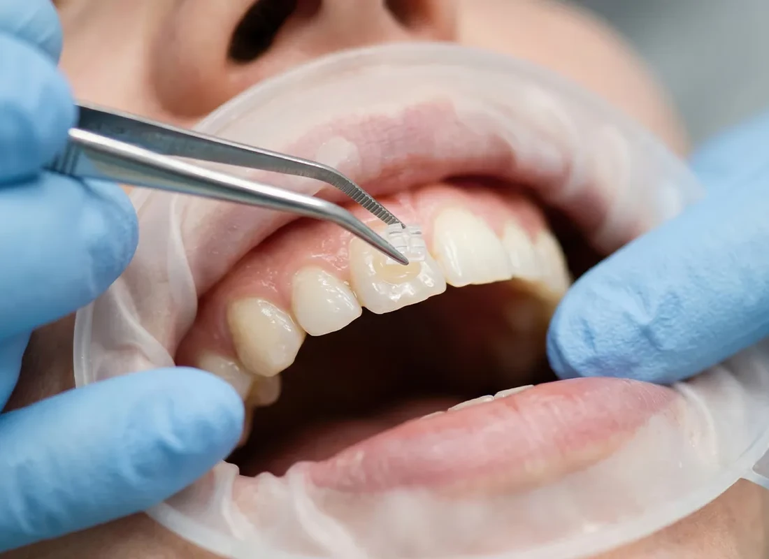 dental-bonding.webp