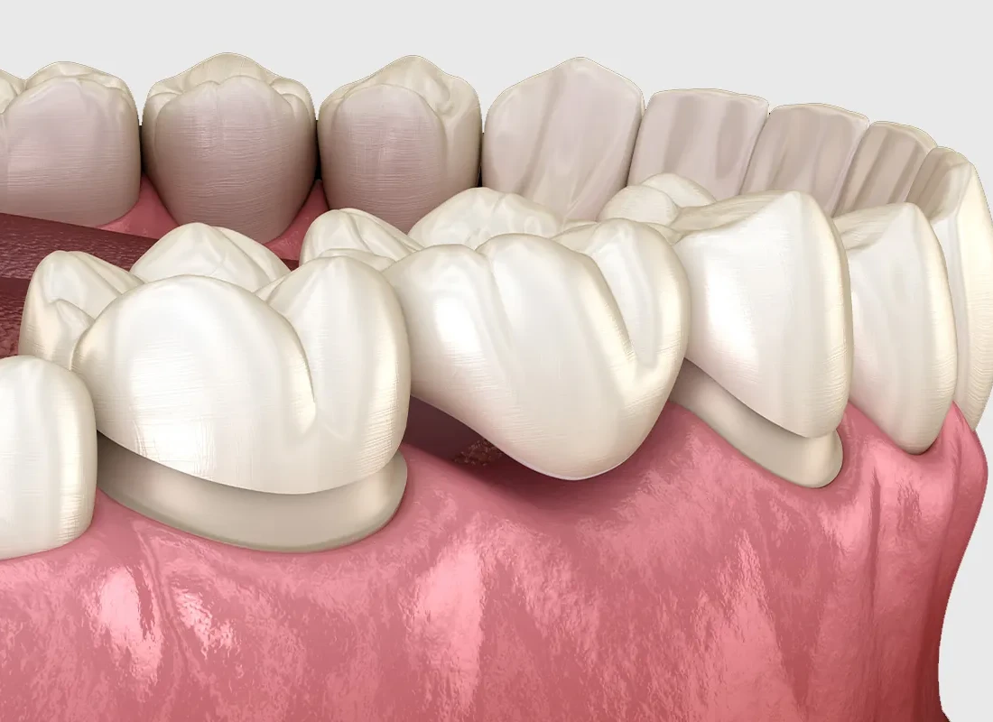 dental-bridge-model.webp