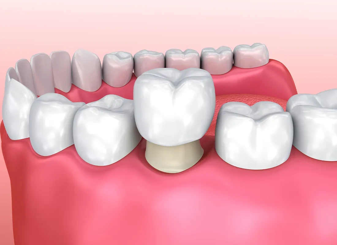 dental-crown-model.webp