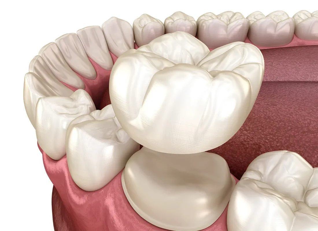 dental-crowns.webp