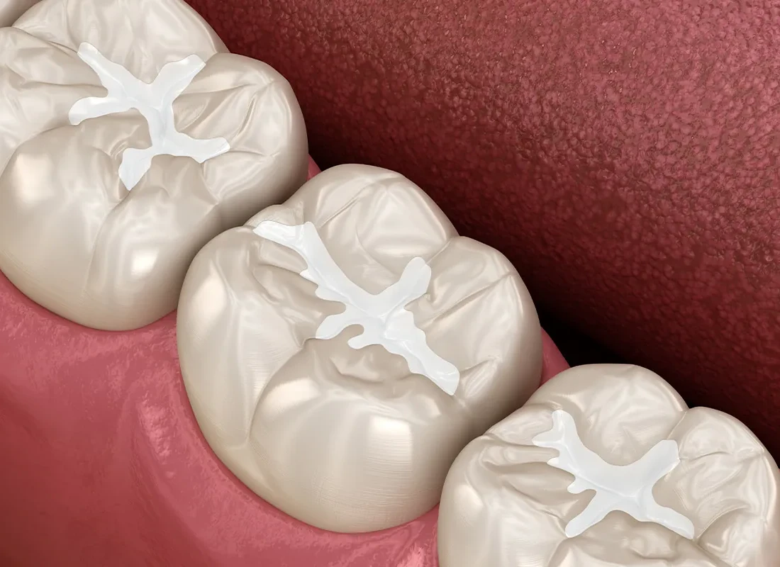 dental-fillings.webp