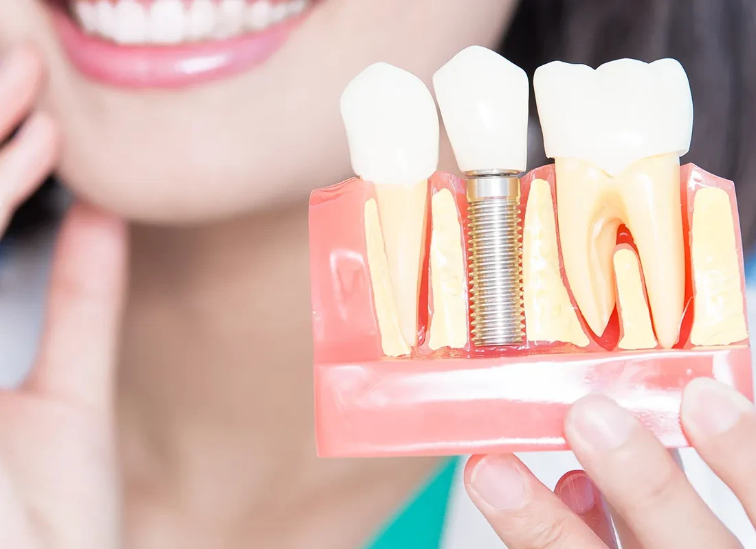 dental-implants-2.webp