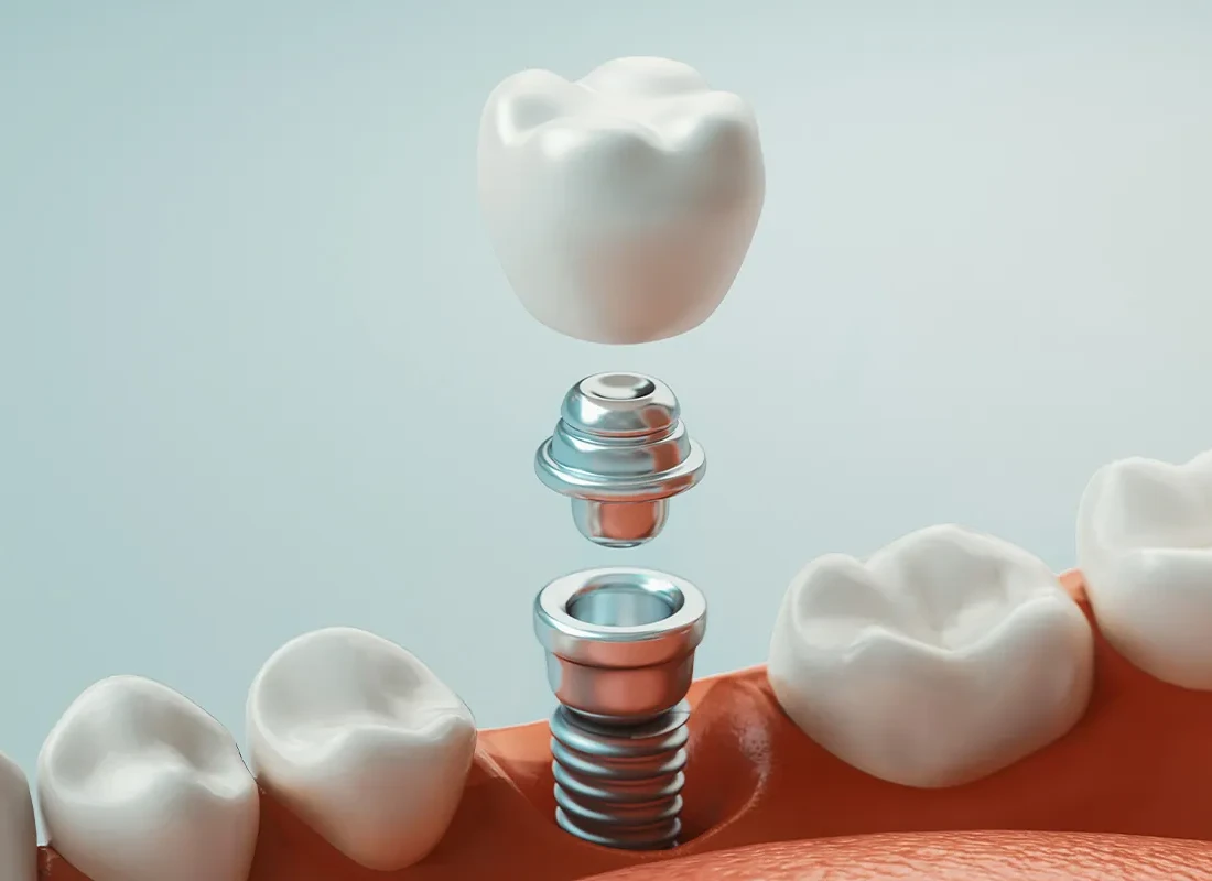 dental-implants-5.webp