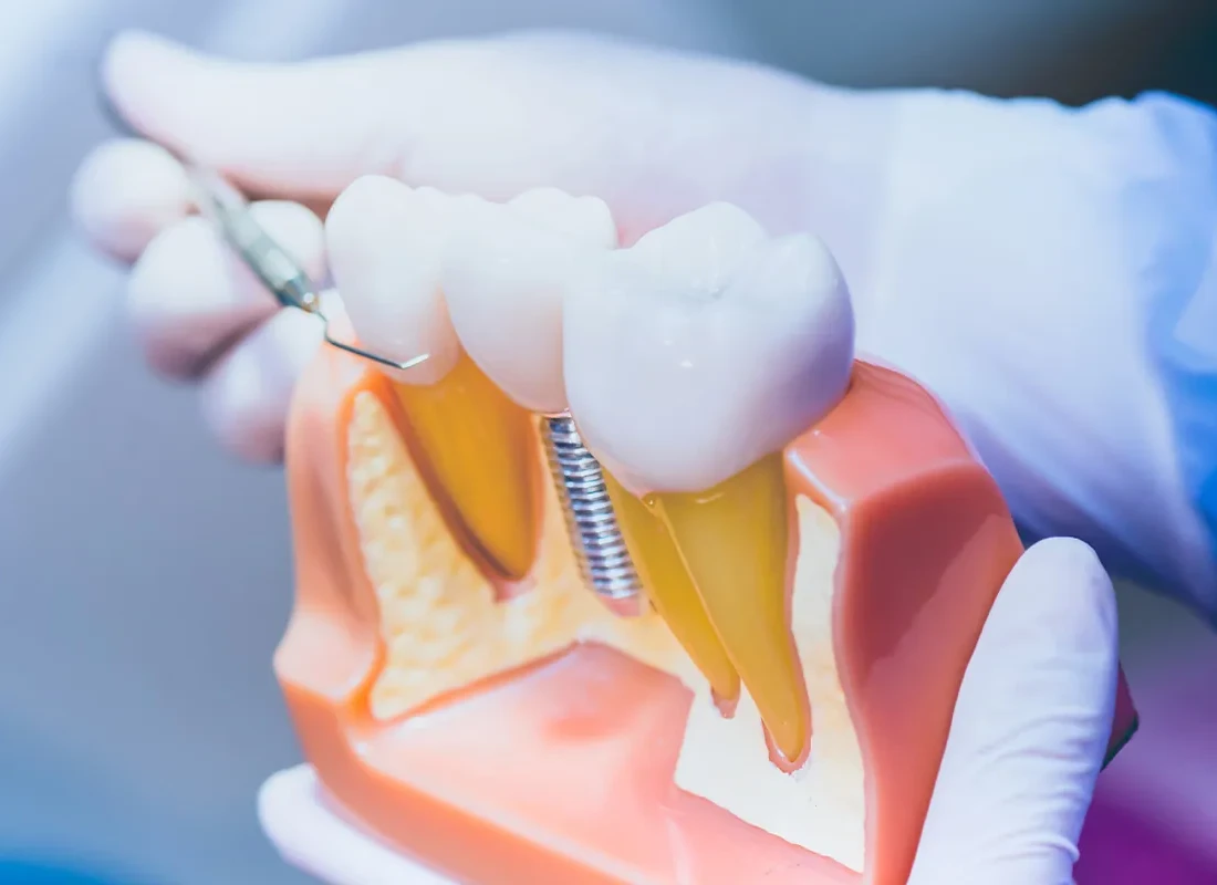 dental-implants.webp