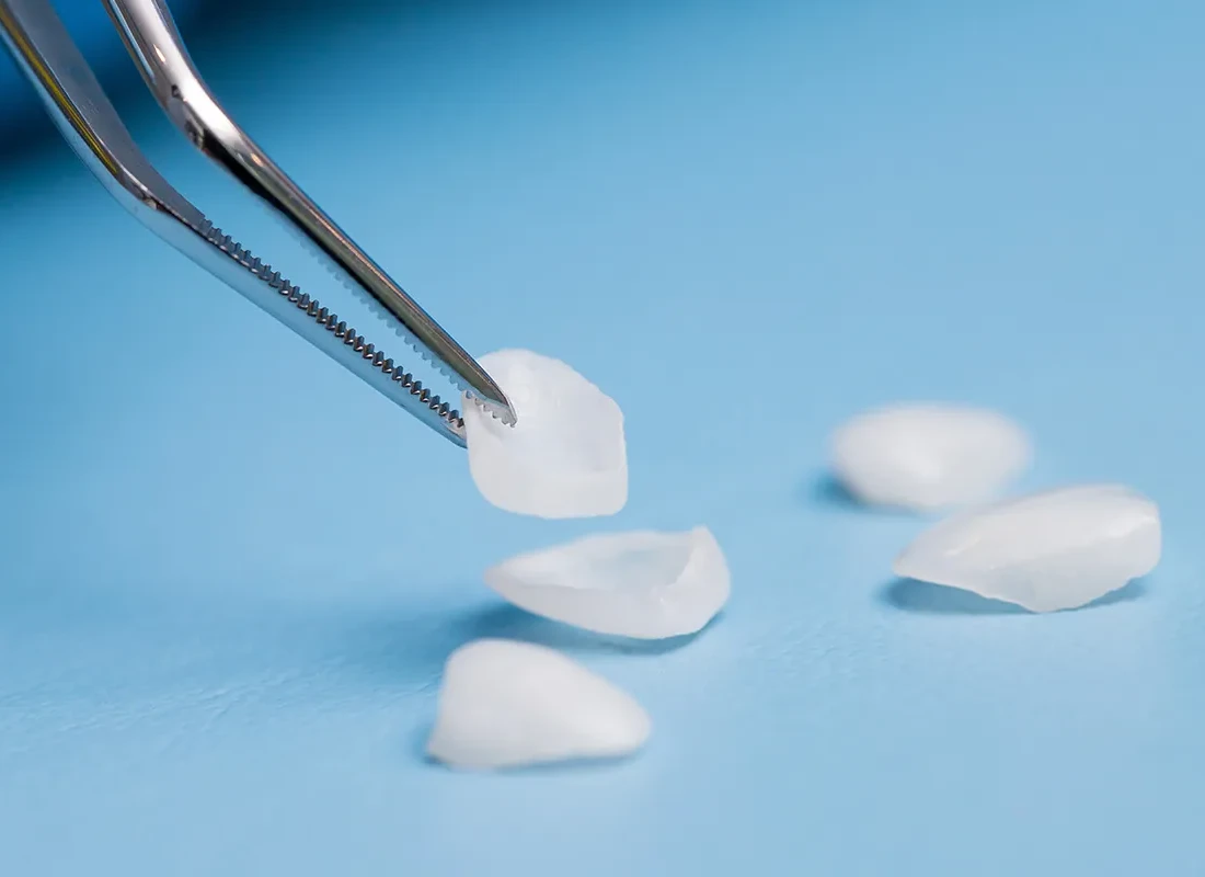Carillas Dentales en Exceptional Dentistry
