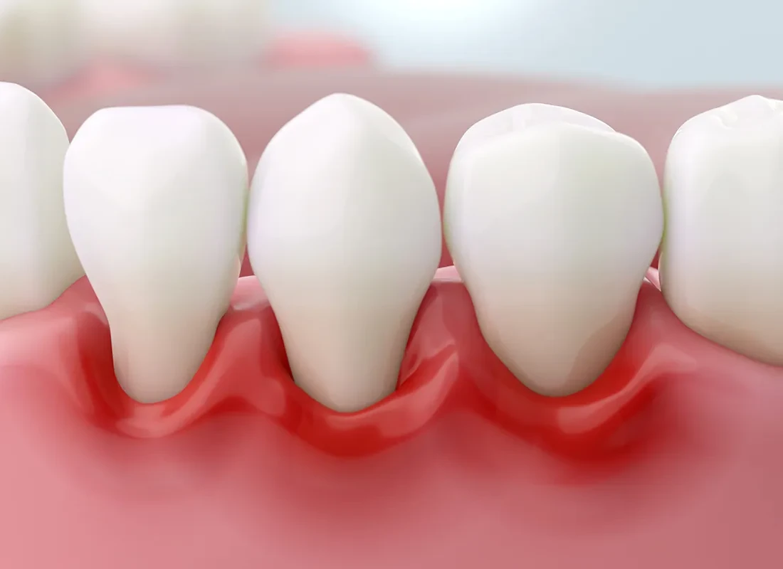 gum-health.webp