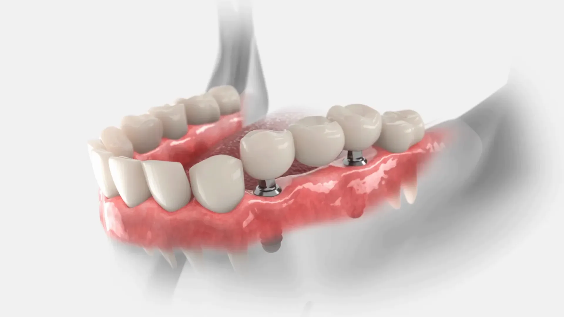implant-bridge-1.webp