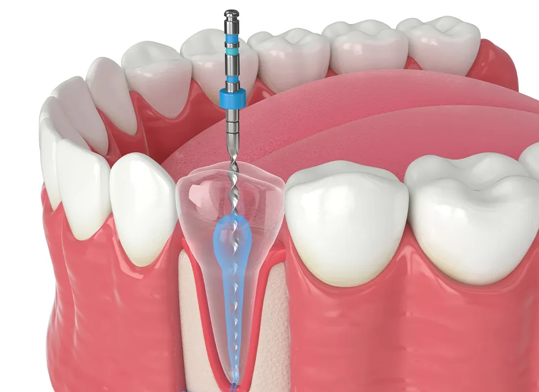 root-canal-treatment-5.webp