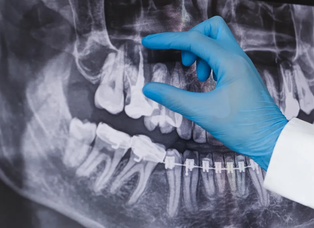 root-canal-x-ray.webp