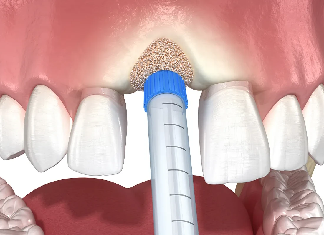 sinus-lift.webp