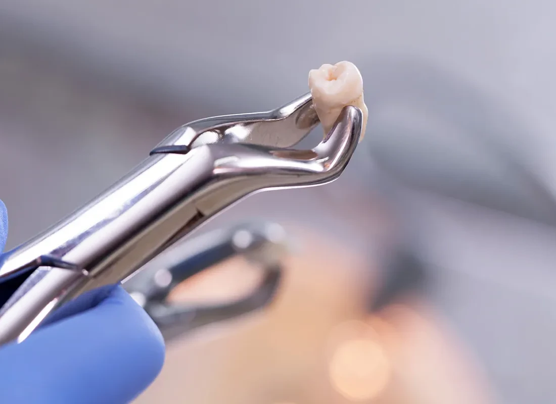 tooth-extraction-2.webp