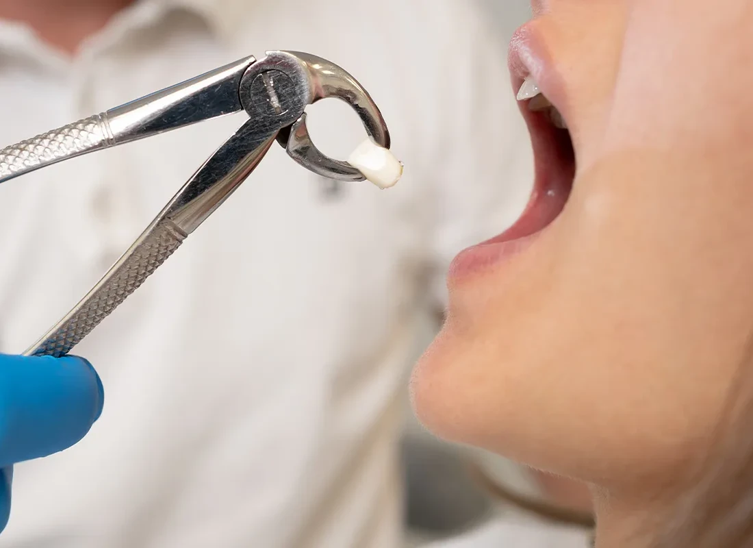 tooth-extraction.webp
