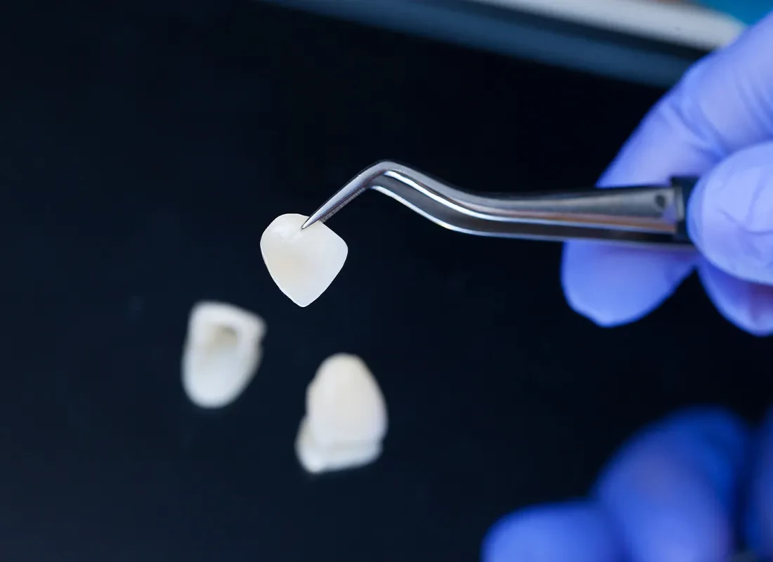 Carillas Dentales en Exceptional Dentistry