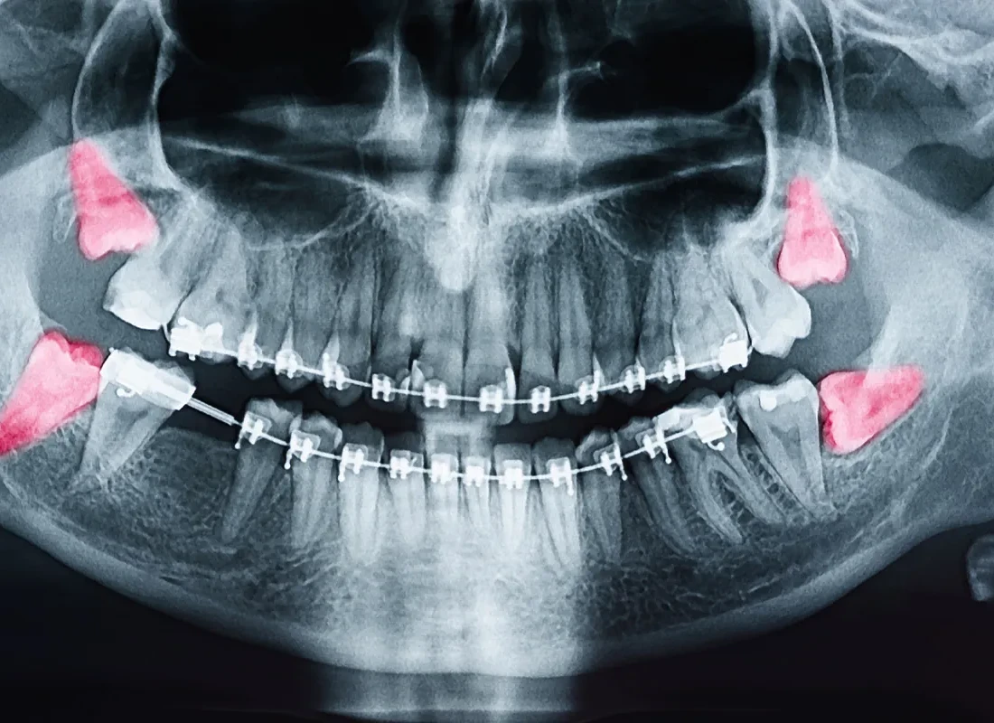 wisdom-teeth-x-ray.webp